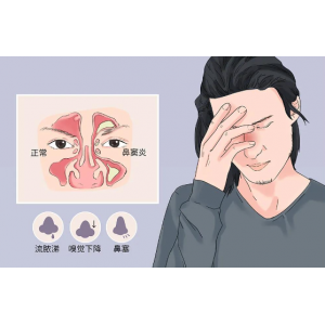 感冒竟是鼻竇炎的元兇？？？