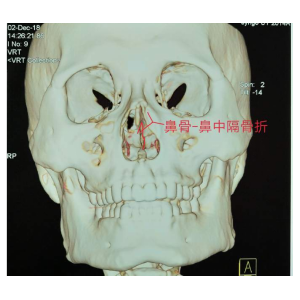 貴陽銘仁耳鼻喉醫(yī)院提醒您：鼻子很脆弱，要好好保護(hù)