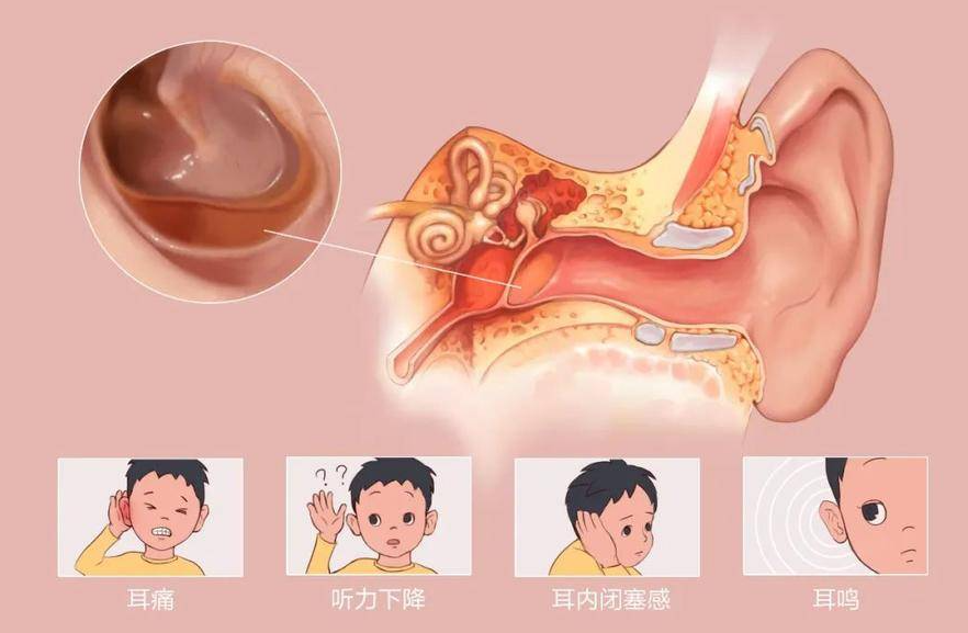 專家提醒小炎癥大危害，別讓外耳道炎毀掉你的聽(tīng)力！(圖2)