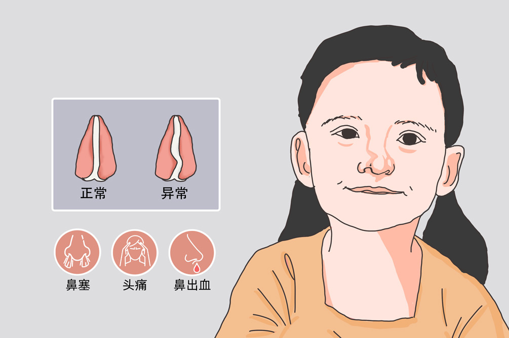 鼻中隔偏曲會(huì)導(dǎo)致睡眠障礙，甚至誘發(fā)心血管疾病？(圖2)