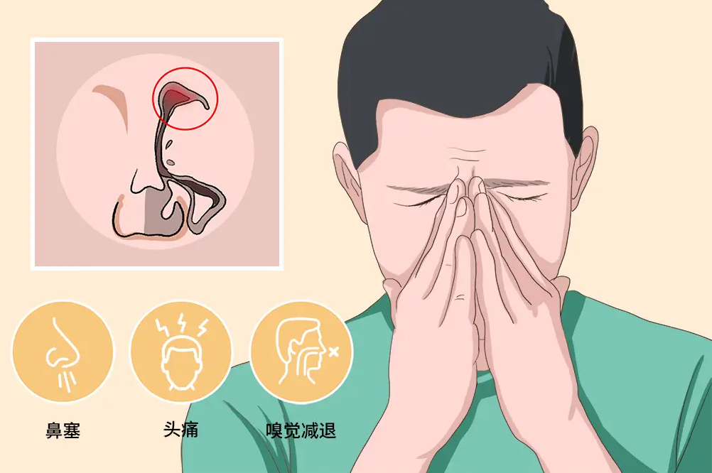 頭疼，鼻子不通氣……鼻竇炎怎么辦？試試這幾招(圖1)