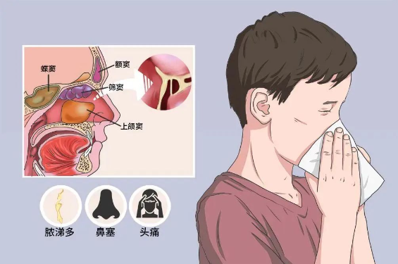頭痛欲裂是感冒？不不不，很有可能是慢性鼻竇炎(圖2)